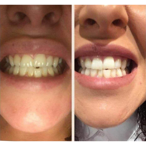 Real customer whitening result