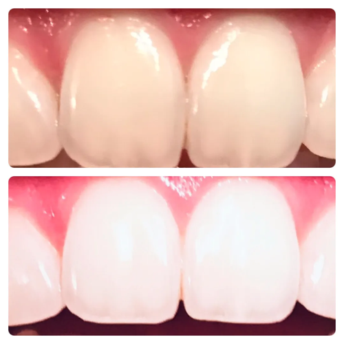 Real customer whitening result