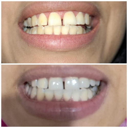 Real customer whitening result