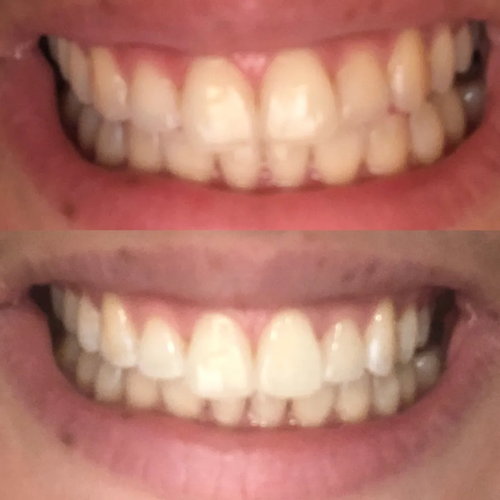 Real customer whitening result