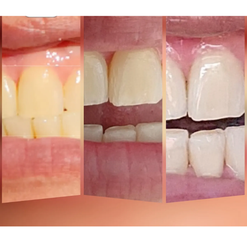 Real customer whitening result