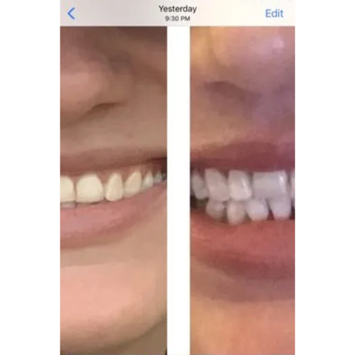 Real customer whitening result