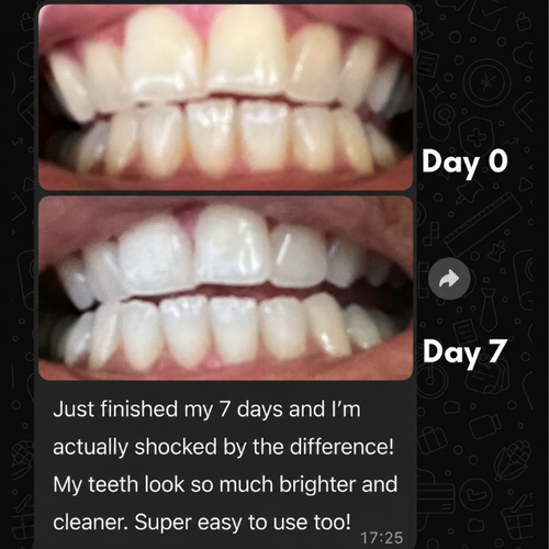 Real customer whitening result