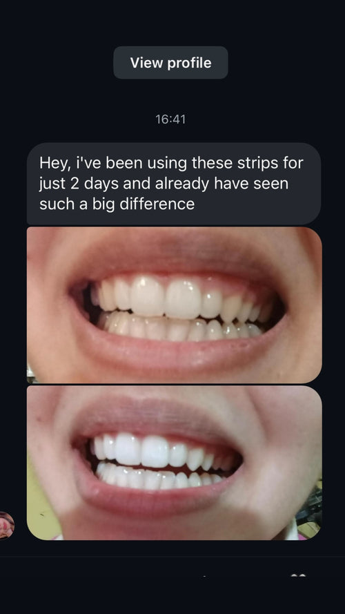 Real customer whitening result
