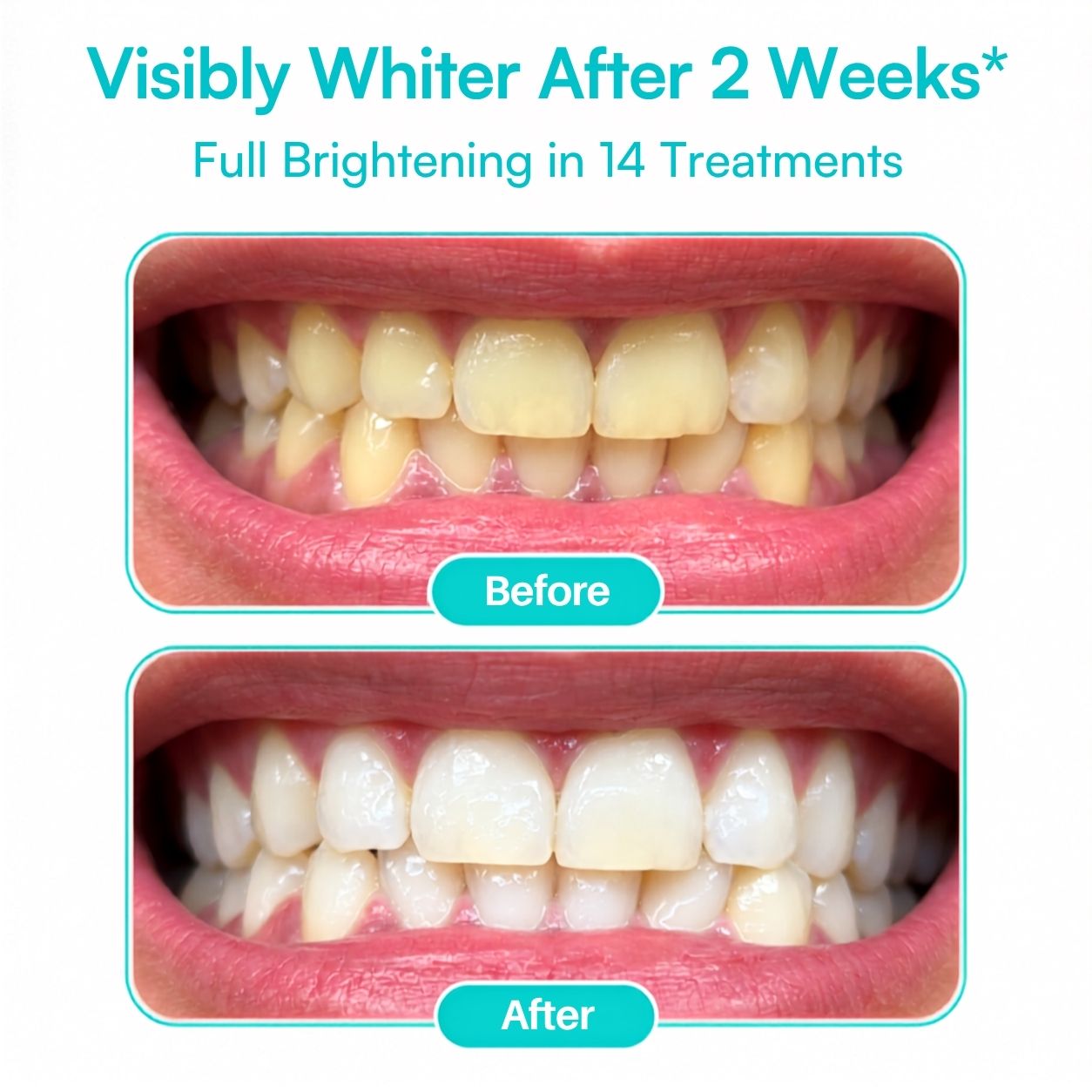 Mimba 6% Teeth Whitening Strips - USA-developed formulation 🇺🇸