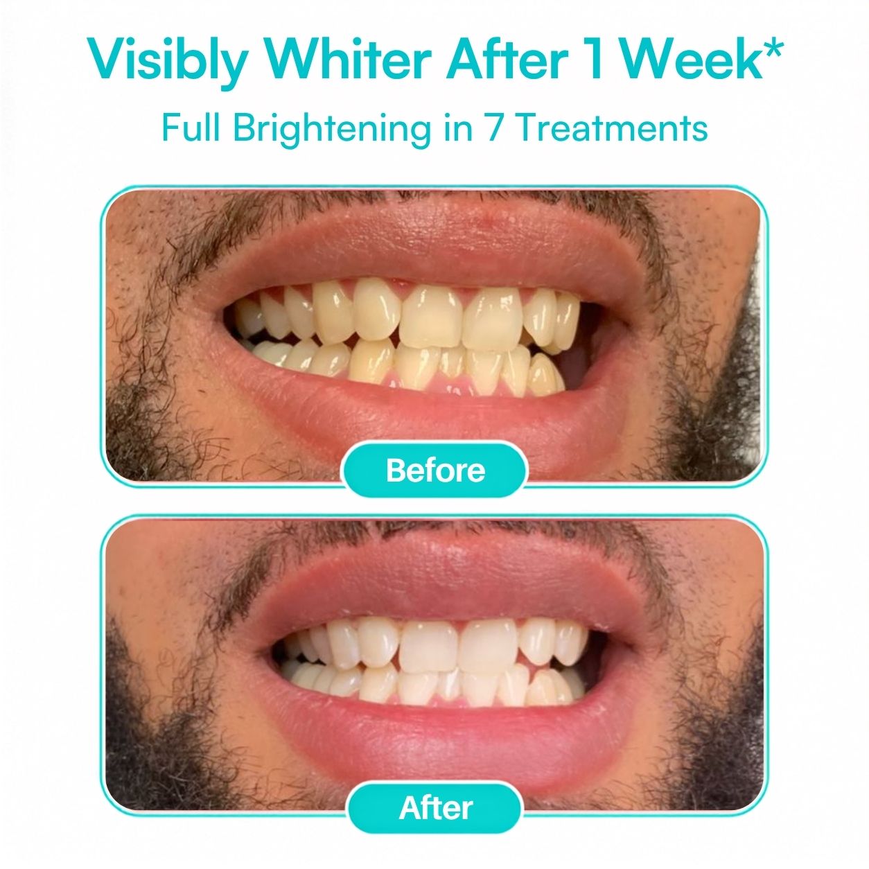 Mimba Pro 10% Teeth Whitening Strips - USA-developed formulation 🇺🇸