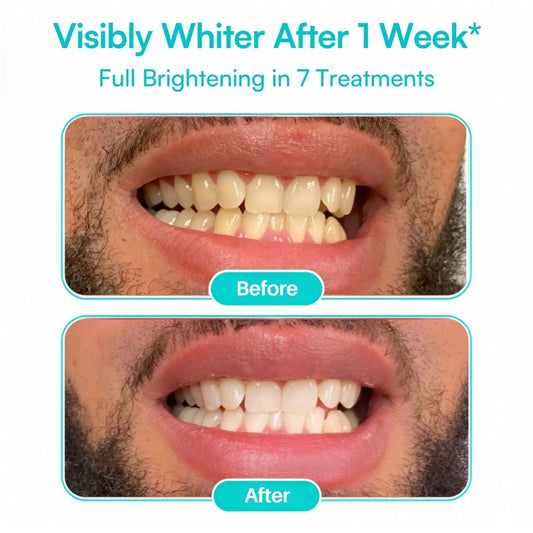 Mimba Pro 10% Teeth Whitening Strips - USA-developed formulation 🇺🇸