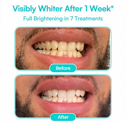Mimba 6% Teeth Whitening Strips - USA-developed formulation 🇺🇸