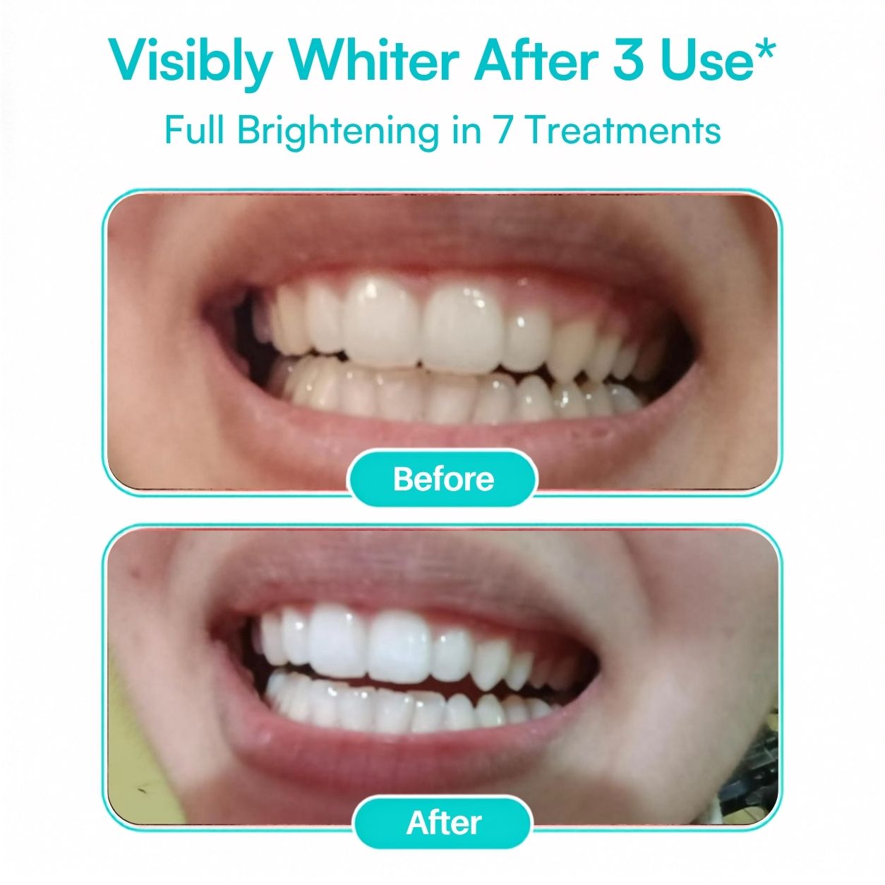 Mimba 6% Teeth Whitening Strips - USA-developed formulation 🇺🇸