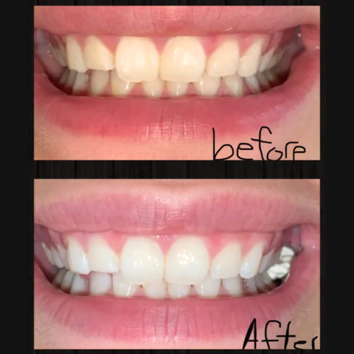 Real customer whitening result