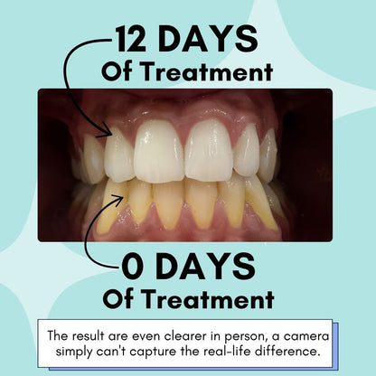 Mimba Flavored Teeth Whitening Strips