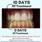 Mimba Teeth Whitening Strips - USA-developed formulation 🇺🇸