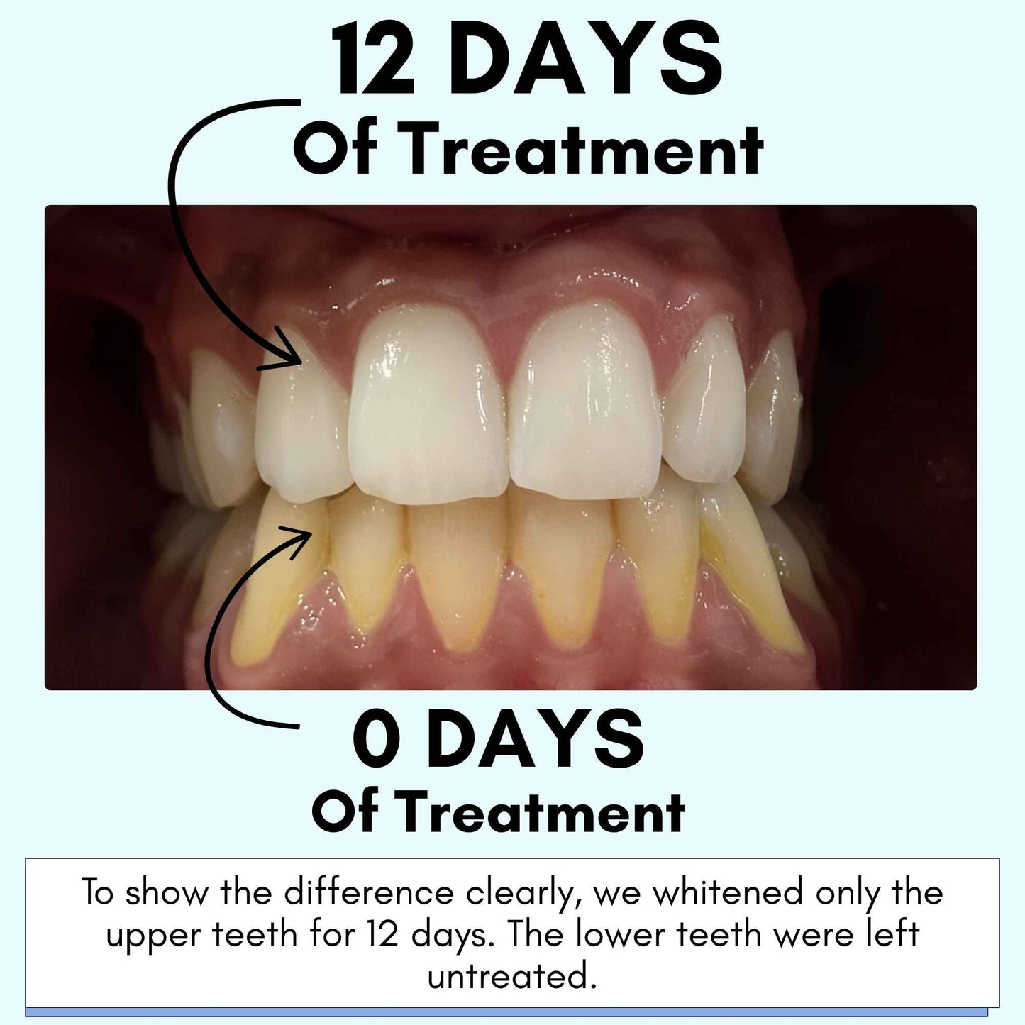 Mimba 6% Teeth Whitening Strips - USA-developed formulation 🇺🇸