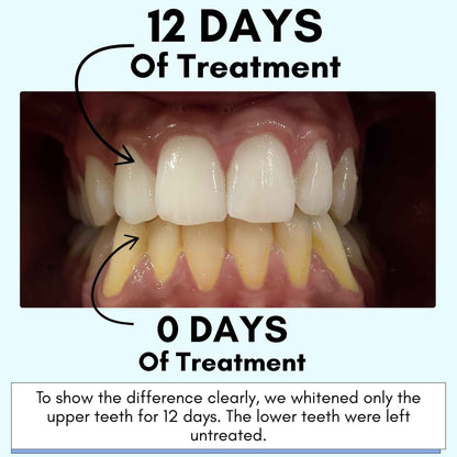 Mimba 6% Teeth Whitening Strips - USA-developed formulation 🇺🇸